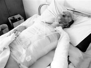 周小姐的頭、頸、軀干、四肢均被燒傷，其中面部燒傷最為嚴(yán)重。