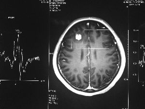 方框亮點為CT片顯示的異物 方框亮點為CT片顯示的異物