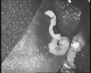 取出的蟲子在顯微鏡下顯得有些瘆人 取出的蟲子在顯微鏡下顯得有些瘆人