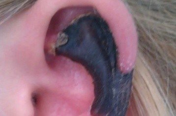 荷蘭女子旅游途中被蜘蛛咬，耳軟骨溶解變黑。