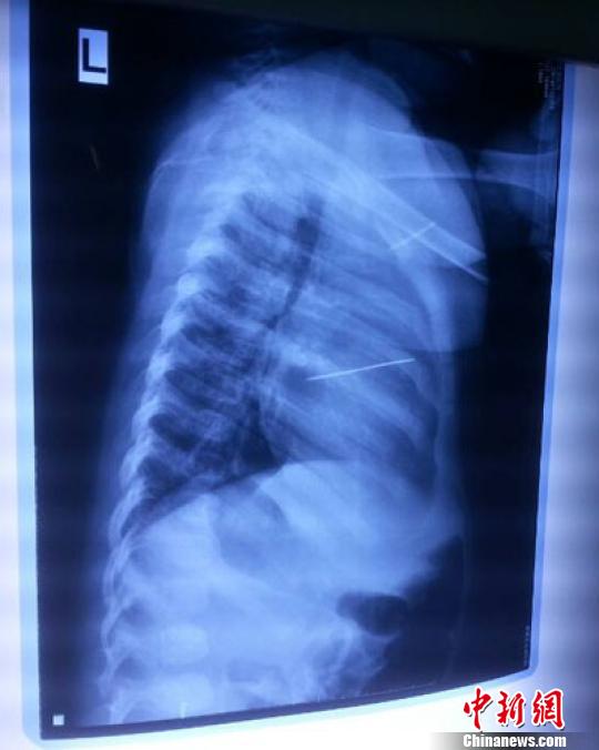 河南心臟被扎針女嬰術后尚未脫險家人渴求真相 河南心臟被扎針女嬰術后尚未脫險家人渴求真相