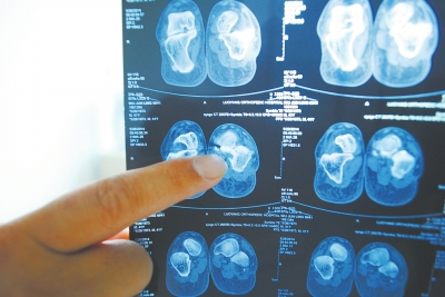 X光片顯示,確實(shí)有一根殘留的螺絲釘。