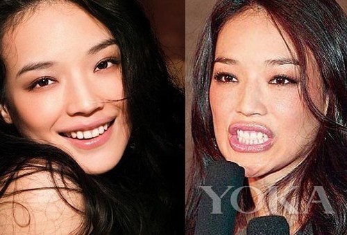 牙齒凸出，口輪肌過(guò)于松弛