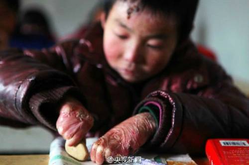 男孩皮膚一碰就破 裹衛(wèi)生紙堅持上學(xué) 男孩皮膚一碰就破 裹衛(wèi)生紙堅持上學(xué)