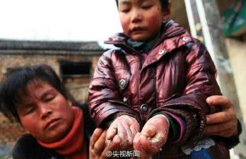 男孩皮膚一碰就破 裹衛(wèi)生紙堅持上學(xué) 男孩皮膚一碰就破 裹衛(wèi)生紙堅持上學(xué)