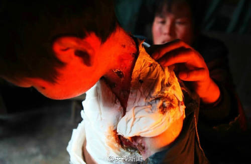 男孩皮膚一碰就破 裹衛(wèi)生紙堅持上學(xué) 男孩皮膚一碰就破 裹衛(wèi)生紙堅持上學(xué)