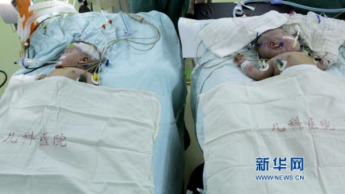 一對(duì)連體女嬰成功分離