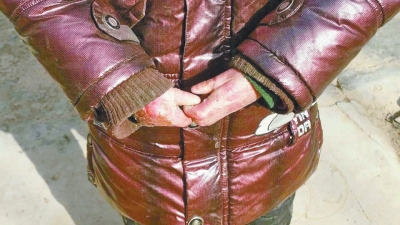 長期受損的手指，已經(jīng)長在了一起。