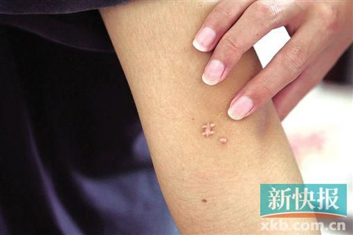 取出針后李星兒手臂留下了傷口。新快報記者 張國鋒/攝