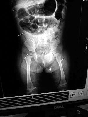 目前體內(nèi)的12根鋼針多分布在孩子的臀部，一根在腹部，其余3根在胸腔附近，其中一根很接近心臟