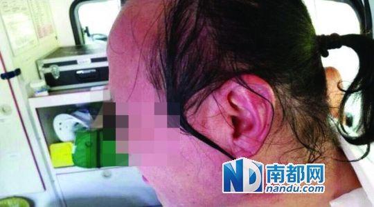 涉事教師遭熱水潑臉后的照片。 涉事教師遭熱水潑臉后的照片。