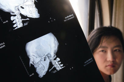 國內(nèi)醫(yī)院CT顯示，如今靳魏坤的鼻子假體是歪的，連下巴也是歪的