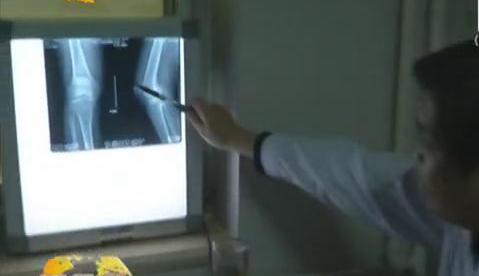 冷空氣來(lái)襲 如何預(yù)防老寒腿？